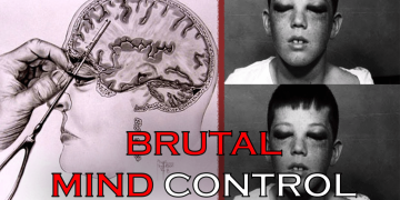 Lobotomy: Unravelling the Controversial History of a Mind-Altering Procedure